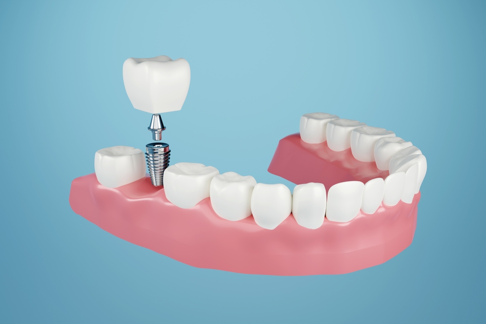 Dental Implants for Missing Teeth