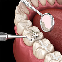 Tooth Fillings in Kukatpally